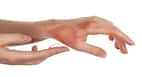 Top 5 home remedies to heal burn injuries and scars in no time