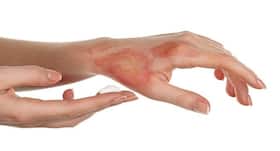 Top 5 home remedies to heal burn injuries and scars in no time