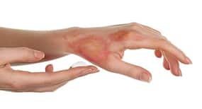 Top 5 home remedies to heal burn injuries and scars in no time