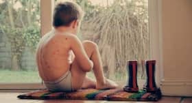 What are the natural remedies for chicken pox?
