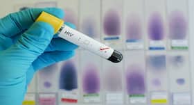Top 6 alternative therapies that ease out symptoms of HIV