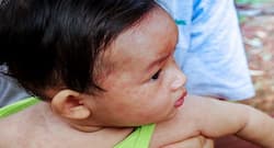 Top 9 ways to cure measles naturally
