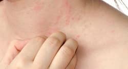 Study finds melanoma death rate rising in men