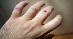 Here's how you can treat warts using lemon