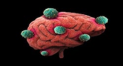 This novel drug can block the spread of glioblastoma