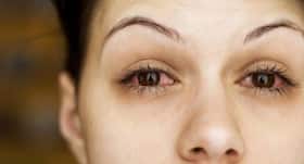Doctors says air pollution may severely affect eyes