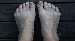 Want to treat foot lumps? Try these fool-proof remedies