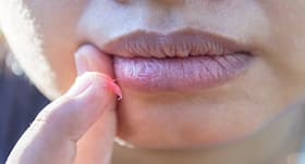 Tips to get rid of white spots on lips