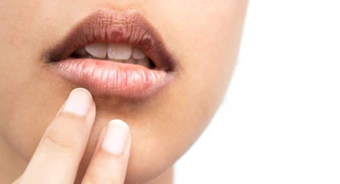 Brown Spots On Lips Causes