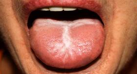Follow these home remedies get rid of oral thrush