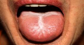 Follow these home remedies get rid of oral thrush Follow these home remedies get rid of oral thrush