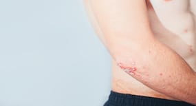 Top 4 triggers that can make psoriasis worst