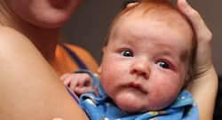 6 few tips to combat atopic dermatitis in babies