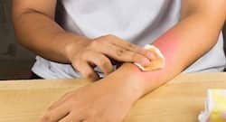 Easy tips to treat minor burns at home