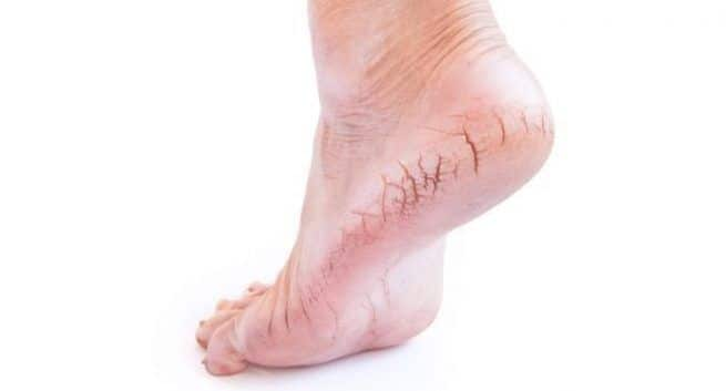 cracks in your feet