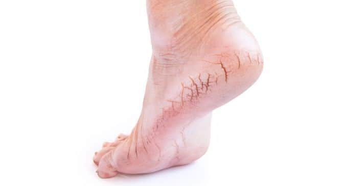 Symptoms and Conditions - Dry, Rough and Cracked Skin – DrScholls