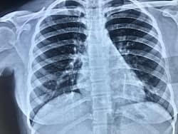 बिना सर्ज़री डॉक्टरों ने निकाली फेफड़े में फंसी 3.5 सेमी की पिन, 18 साल की लड़की को मिली नयी ज़िंदगी