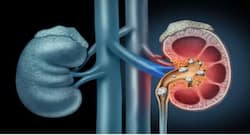 5 ways to dissolve kidney stones naturally
