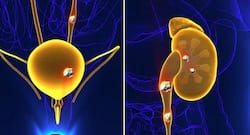 अमरिदर सिंह के गुर्दे से पथरी निकालने की हुई सफल सर्जरी