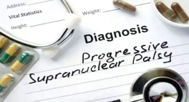 progressive-supranuclear-palsy