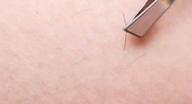4 ways to treat the ingrown hair at home