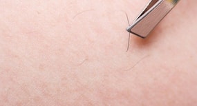 4 ways to treat the ingrown hair at home