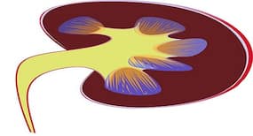 Tips to reduce the risk of kidney stones
