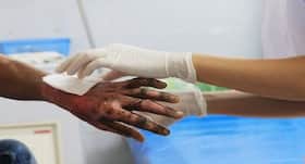 Artificial skin with sensing properties could help burn victims in future