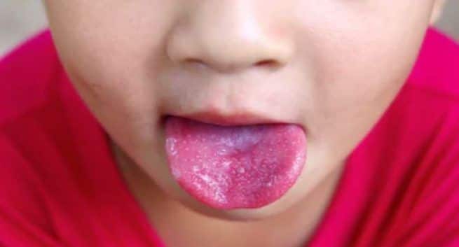 fever-and-Vitamin-C