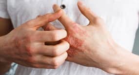 Treat your itchy skin naturally