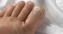 Suffering from toenail fungus? Follow these home remedies