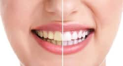 Try these natural remedies to whiten your teeth