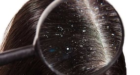 Follow these home remedies to tackle dandruff