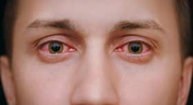 Red eyes may be due to an infection: Know how to deal with it