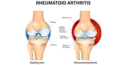 Rheumatoid arthritis: Try these yoga asanas to get some relief