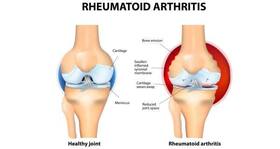 Rheumatoid arthritis: Try these yoga asanas to get some relief