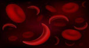 Sickle-cell-anaemia