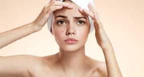 Want to get rid of black spots on your face? Go the natural way