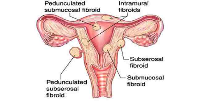 Why Do Uterine Fibroids Cause Back Pain - AFC