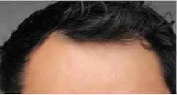 सिर के आगे नजर आने लगा है गंजापन, ट्राई करें ये उपाय एक महीने में आ जाएंगे दोबारा बाल