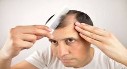 गंजेपन की सबसे बड़ी वजह है पोषण की कमी, डायट में करें इन्हें शामिल