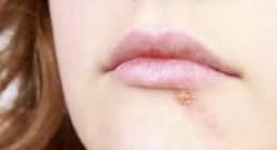 Avoid these things if you are suffering from herpes