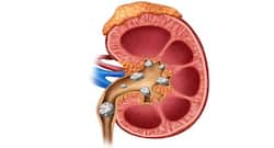 Know these ways to dissolve kidney stones naturally