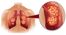 Lung cancer: Here's how yoga can help