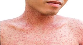 Watch out for these signs of measles