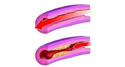 Watch out for these silent signs of clogged arteries