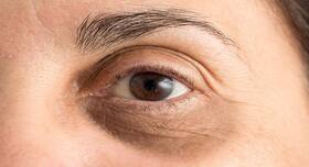 6 home remedies that help you get rid of dark circles