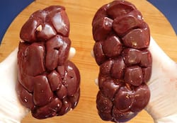 किडनी स्टोन होने पर फंक्शन ऑफ किडनी पर क्या प्रभाव पड़ता है