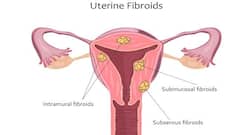 Uterine fibroid: The treatments you need to know about