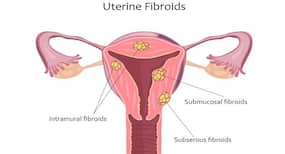 Uterine fibroid: The treatments you need to know about